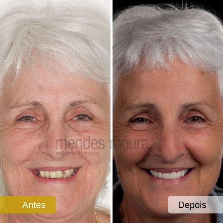 Implantes Dentários - Mendes Moura