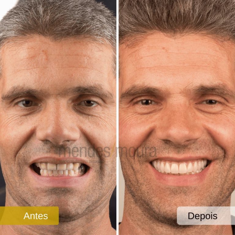 implantes dentários Dentes em um Dia - antes e depois