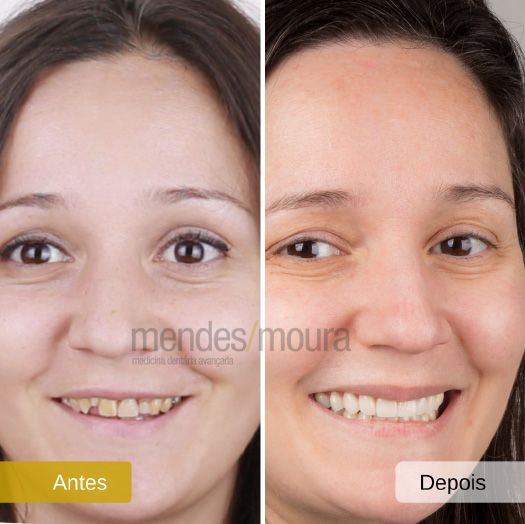facetas dentárias